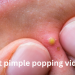 best pimple popping videos
