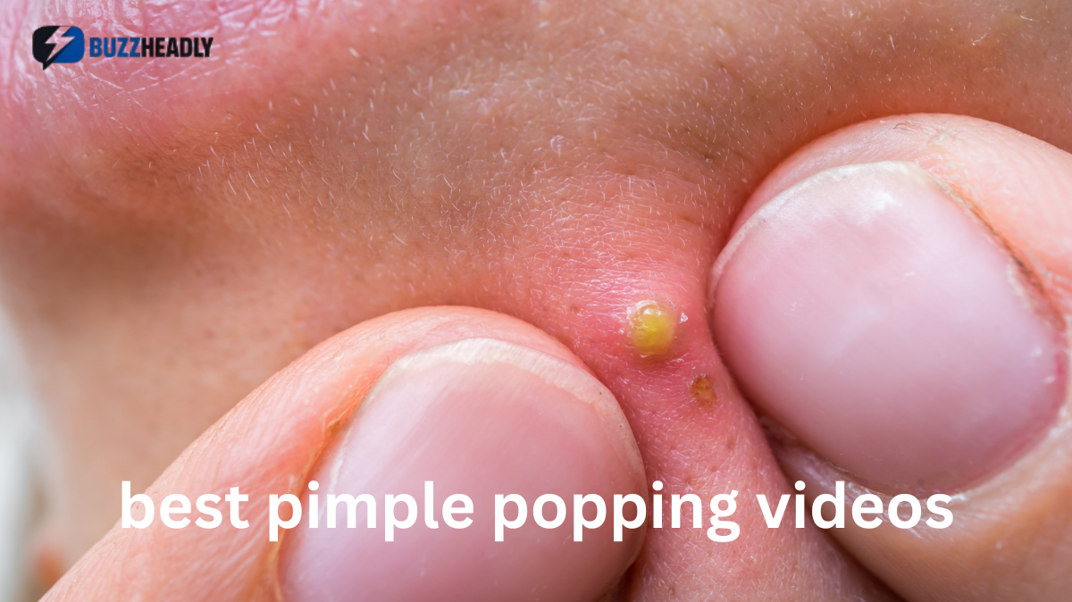 best pimple popping videos
